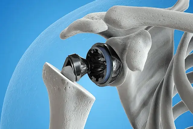Digital view of joint replacement device with a blue background